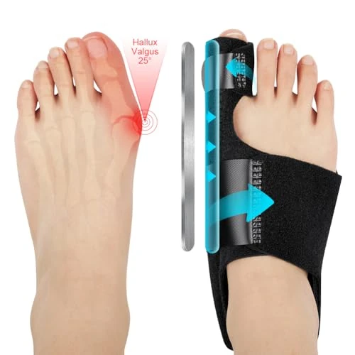 Tijdelijke aanbieding: Acwoo Hallux Valgus Correctiesalk, 2 spalk- en X-teen-afscheiders, antislip, eeltknobbels, corrector voor mannen en vrouwen van 14.99 € naar 14.99 € (0.00% korting)